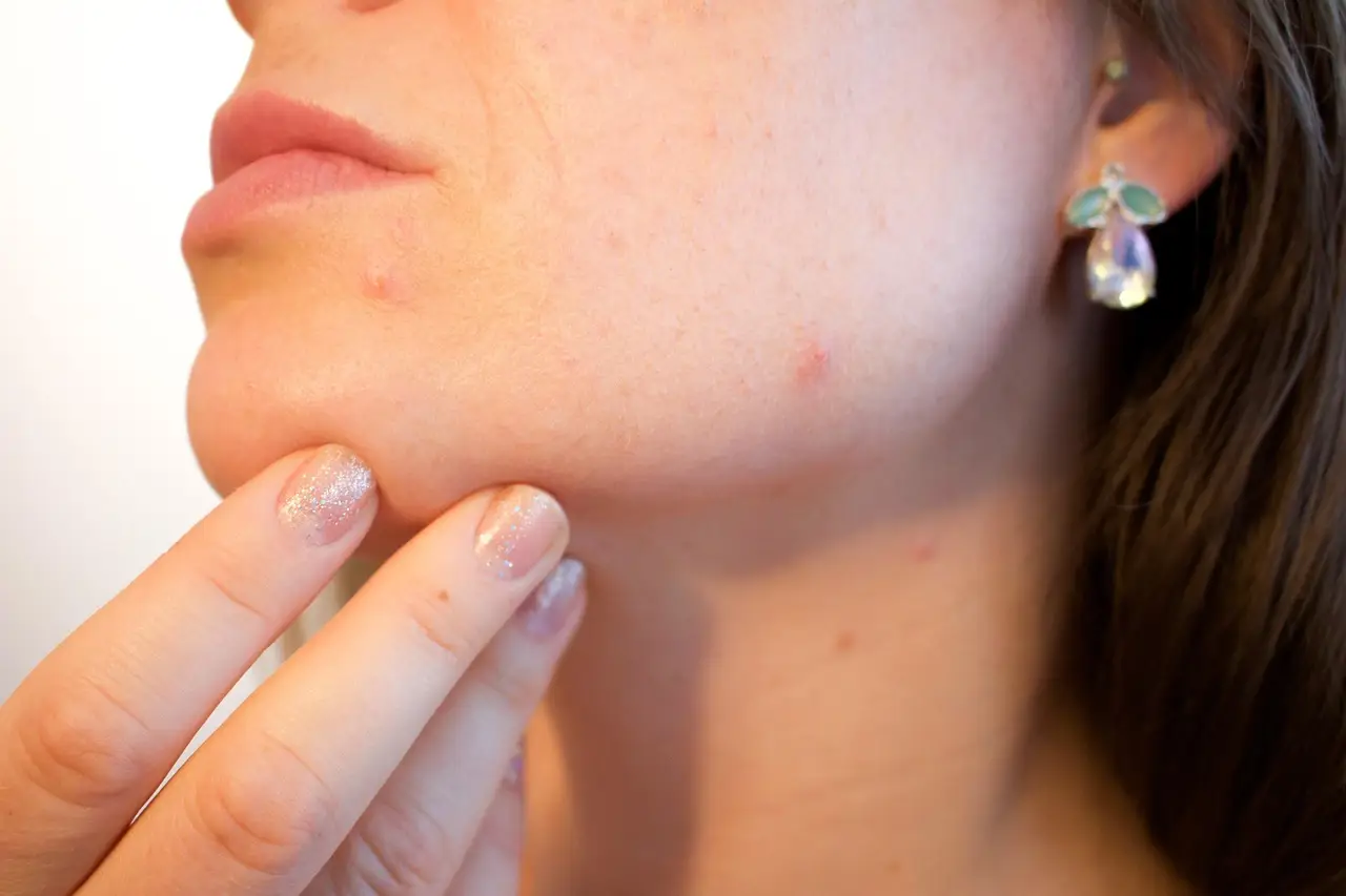 Vitamin Derivative Pantethine Alleviates Psoriasis Symptoms in Small Human Trial